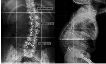 escoleosis2