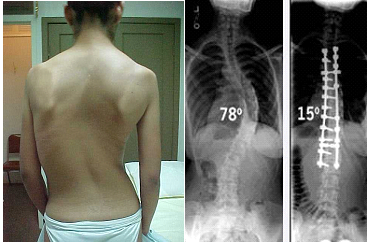 escoleosis5