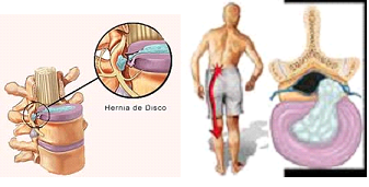 hernia